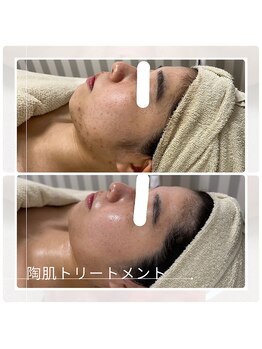 アチェリー(aCherry)/陶肌トリートメント