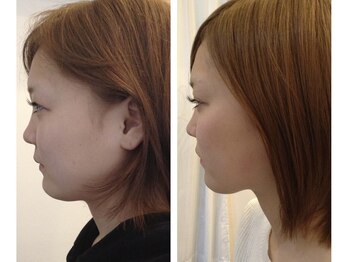 リバース(Re birth)/ビフォーアフター