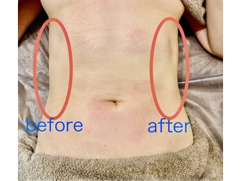 ルトゥーシア(Lotusia)/お腹1回　before→after