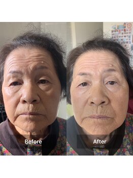 ヨサ パーク コアハート(YOSA PARK CORE HEART)/テラパーミア1回の効果