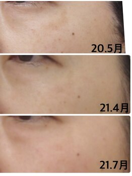 ソワンマリア(soin Maria)/更年期のシミケアに最適エステ!