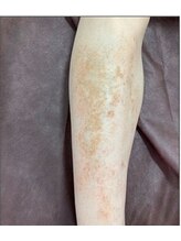 リベル 名古屋(Lebelle:)/ハーブピーリング専門名古屋