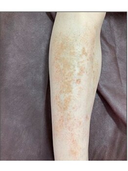 リベル 名古屋(Lebelle:)/ハーブピーリング専門名古屋