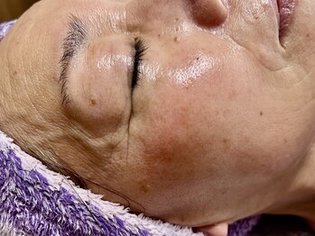 ローズ 下松(ROSE)/68歳光フェイシャル＋ヒト幹細胞