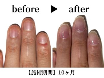 リング ザ ベル(ring the bell)/深爪プレミアムコース¥18,700