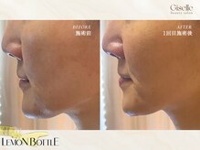 ジゼル(Giselle)/【レモンボトル】お客様B＆A