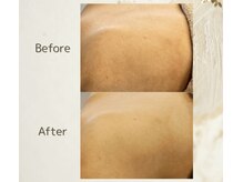 アンダブル(Andouble)/ビフォーアフター(背中)