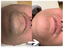 Private salon one-shotの雰囲気（濃いひげもスッキリ美肌に♪）