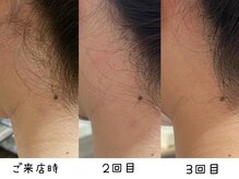 エムズ(emus.)/脱毛施術前と2回目、３回目