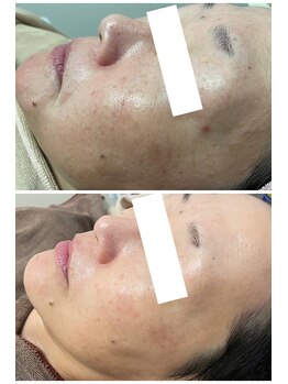 ルーミー(LUME.)/韓国美容の【ララピール】