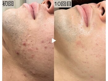 ロワ(Roi)/【肌荒れ改善×顔脱毛】10回施術