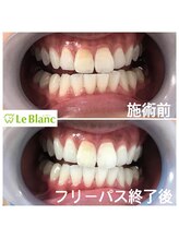 ルブラン 奈良店(Le Blanc)/神経の無い歯は白くなりません