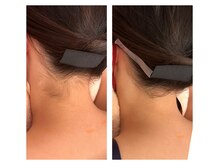 ビーチェ(BICE)/襟足脱毛