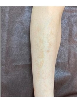 リベル 名古屋(Lebelle:)/ハーブピーリング専門名古屋