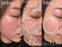 セレソル(CERESOL)/赤みにお悩みの方◎