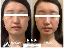 マカオン(machaon)/【小顔リフト】小顔マッサージ