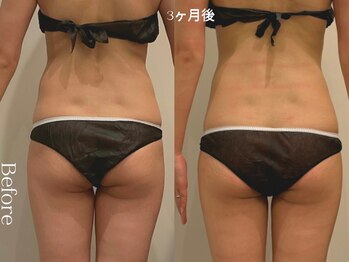 ユーフォリア グロウ(euphoria glow)/{ ラフォス痩身90分 4回 }