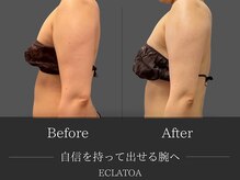 【次世代脂肪冷却・小顔ハイリフト専門店】ECLATOA　四日市/痩身/ダイエットの雰囲気（【脂肪冷却】無駄な脂肪へしっかりピンポイントにアプローチ！）