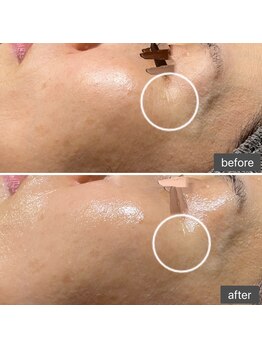 ロッタ エクリュ(Lotta ecru+)/REVI剥けないハーブピーリング