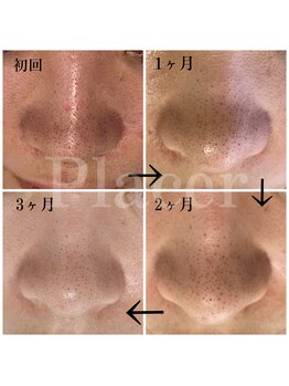 プラセル(Placer)/もう悩まない!