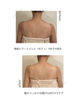 イルソーレ(IL Sole)/日焼け対策/ハーブピーリング