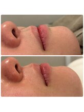 ネオファースト 大阪福島店(NeoFirst)/口元の産毛撲滅！#Wax脱毛