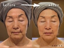 ボウ 静岡本店(VOEUX)/たるみケア　6回