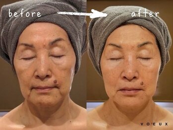 ボウ 静岡本店(VOEUX)/たるみケア 6回