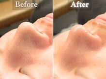 ボーンオム(Born Homme)/毛穴洗浄＋美容液導入：20代女性