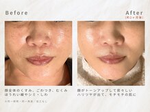 メレ(mele)/50代毛穴／ニキビケア・毛穴