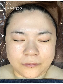シャイニングスター 梅田店(Shining Star)/40代毛穴がお悩みの方