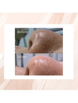 ラティメリア(Latimeria)/毛穴の汚れもごっそり取れます！