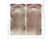 シャルムパリス(charme paris)/毛穴すっきり！１回の施術変化