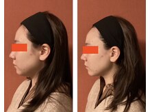 ロイヤリティ(ROYALTY)/2重アゴ、ほほ肉、ほうれい線