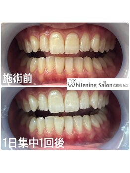 ホワイトニングサロン 京都烏丸店/ホワイトニング施術例