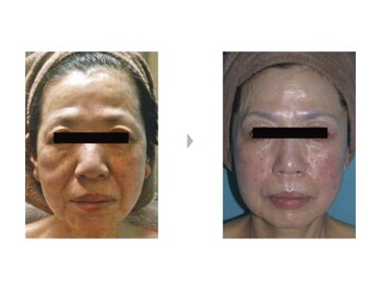 Nビューティー/最新RFサーモシェイプオーパス