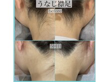 アクト クロ(ACT curro)/ 【うなじ襟足】脱毛施術例