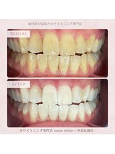 エクシアホワイトニング 札幌中島公園店/Before After［ホワイトニング］