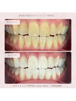 エクシアホワイトニング 札幌中島公園店/Before After［ホワイトニング］