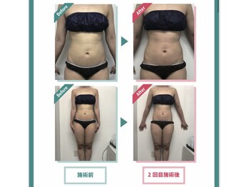 レニフォーメン(reni for men)