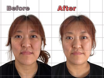 リビット 等々力(Rebit)/BeforeAfter,小顔調整