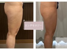 アールグランド 学芸大学店(R-ground)/エンダモロジー太ももアタック