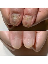 アティックネイルアトリエ(attic nail atelier)/トラブル爪改善コース