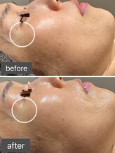 ロッタ エクリュ(Lotta ecru+)/REVI剥けないハーブピーリング