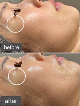 ロッタ エクリュ(Lotta ecru+)/REVI剥けないハーブピーリング