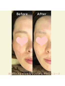 サクラ(Sakura)/美容鍼×ドレナージュコース