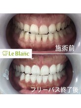 ルブラン 奈良店(Le Blanc)/白い歯で好印象を！