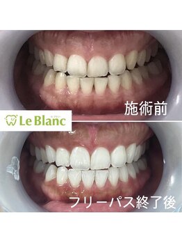 ルブラン 奈良店(Le Blanc)/白い歯で好印象を！