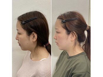 小顔22 ボルティ 赤坂支店(Bolty)/30代：小顔シンメトリー＋整体