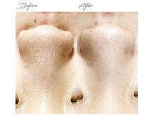 ビズビズ 梅田店(bisebise)/<症例>毛穴詰まり・黒ずみ